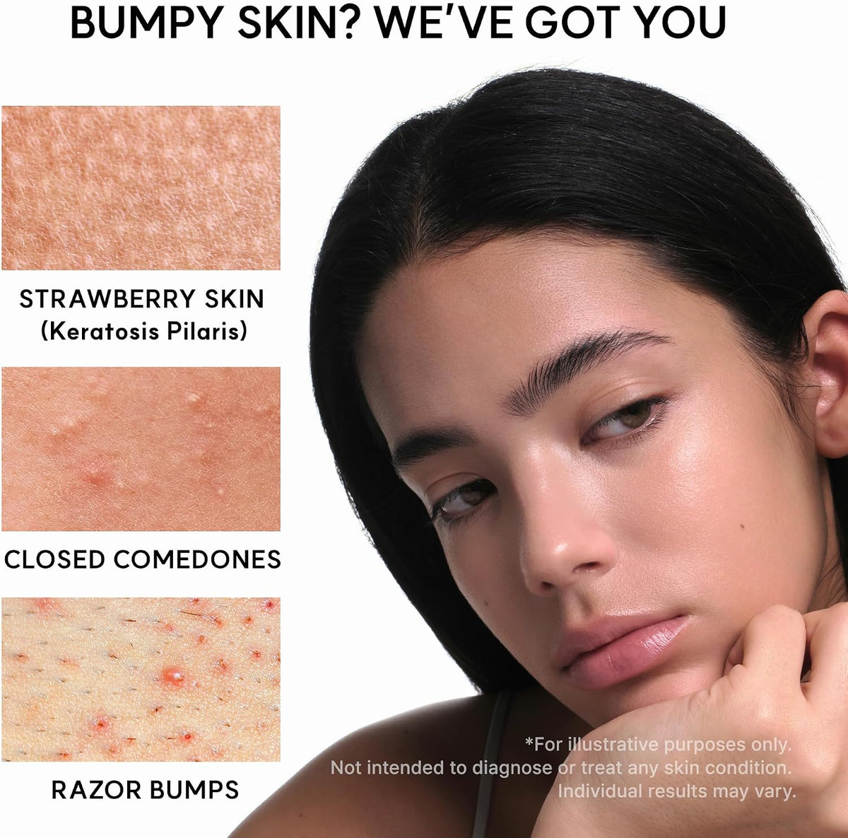 Woman with bumpy skin next to images of strawberry skin, closed comedones, and razor bumps.