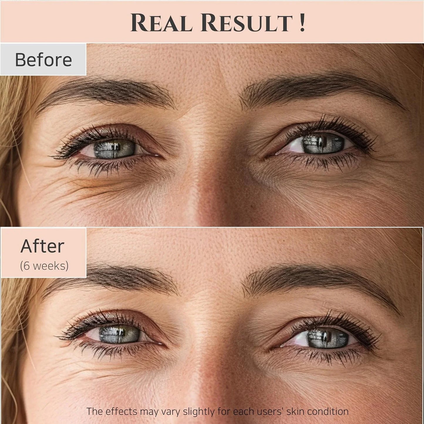 Before and after comparison of eye area treatment showing reduced wrinkles.