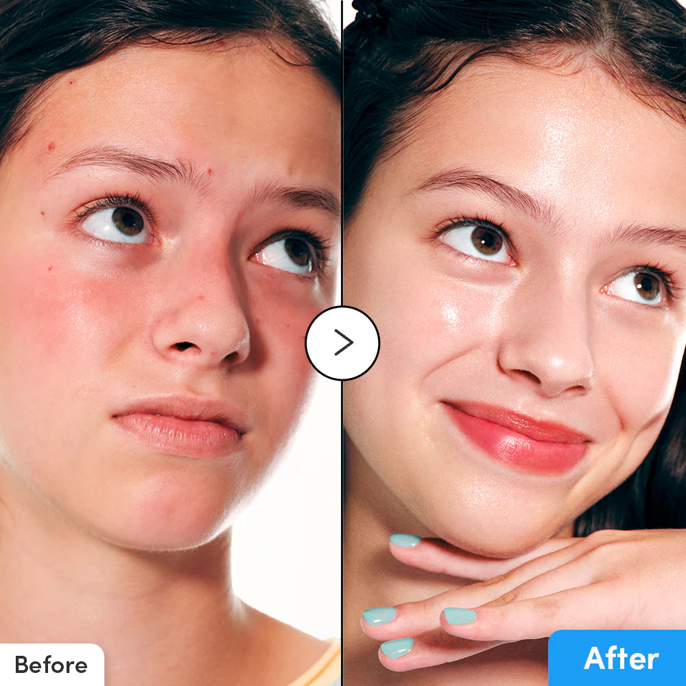 Before and after comparison of a person's face with visible skin improvement.