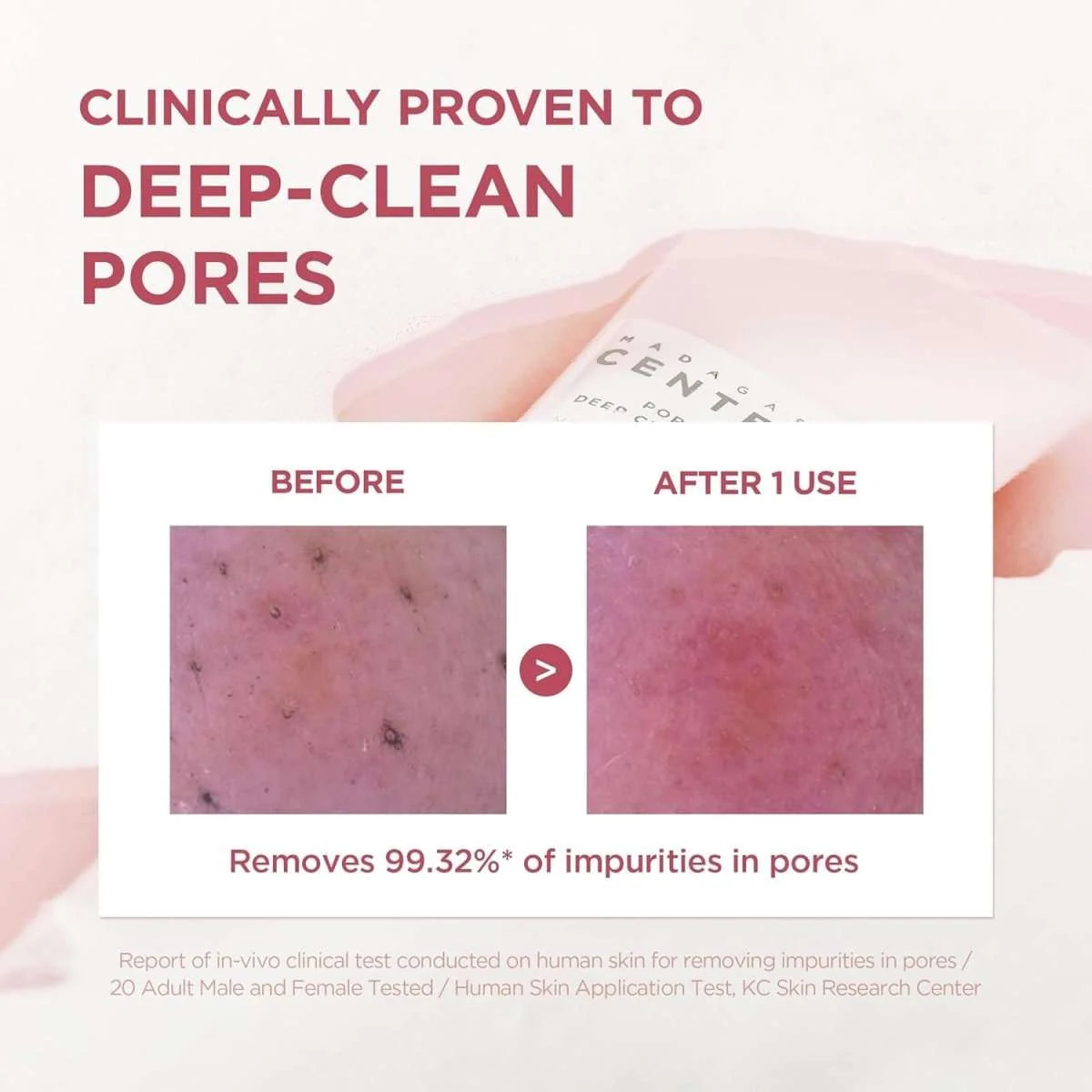 SKIN1004 Poremizing Deep Cleansing Foam deep clean pores before and after