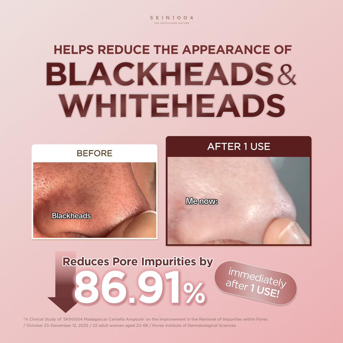 SKIN1004 Poremizing Quick Clay Stick Mask applied to nose and T-zone for pore and sebum care